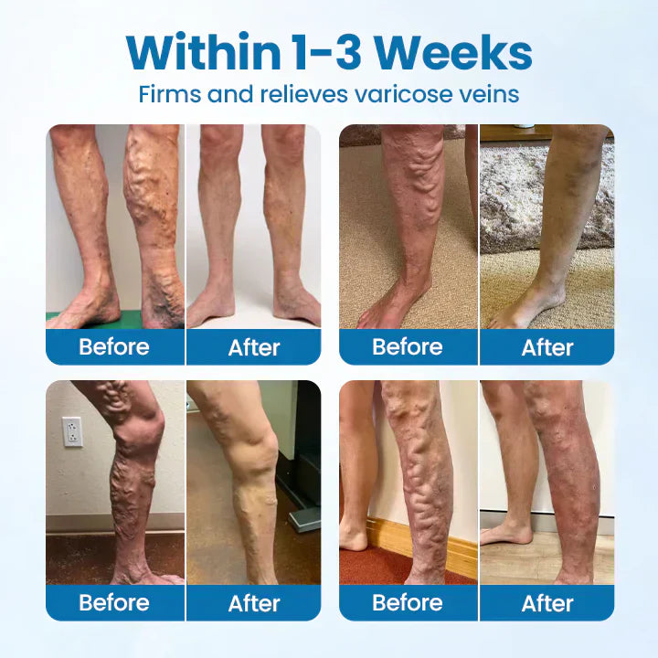 🇨🇦👨‍⚕️✅✅MEDAZY® VeinTarget Microneedle Patch