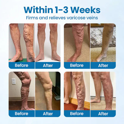 🇨🇦👨‍⚕️✅✅MEDAZY® VeinTarget Microneedle Patch
