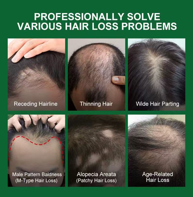 Hair loss concerns including receding hairline thinning hair and wide hair parting